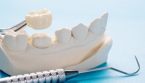 Debunked Myths About Dental Crowns