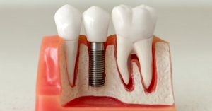 Dental Implants