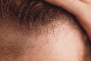 When To Consider a Hair Transplant