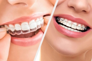 Invisalign vs. Traditional Braces: Which is the Right Choice for You